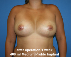 plastic-surgery-breast-augmentation